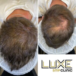 Scalp Micropigmentation St Albans